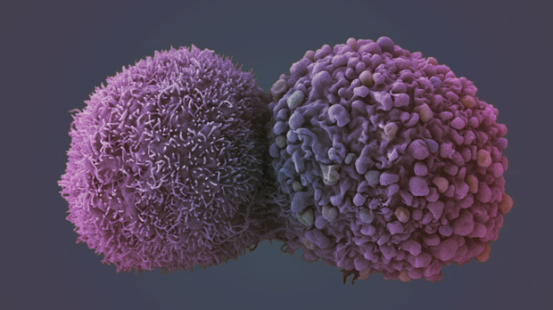 Lung cancer cell (image courtesy of the London Research Institute EM unit).jpg